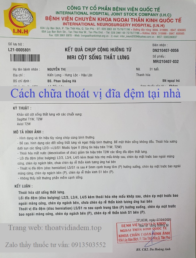 Cách chữa thoát vị đĩa đệm tại nhà